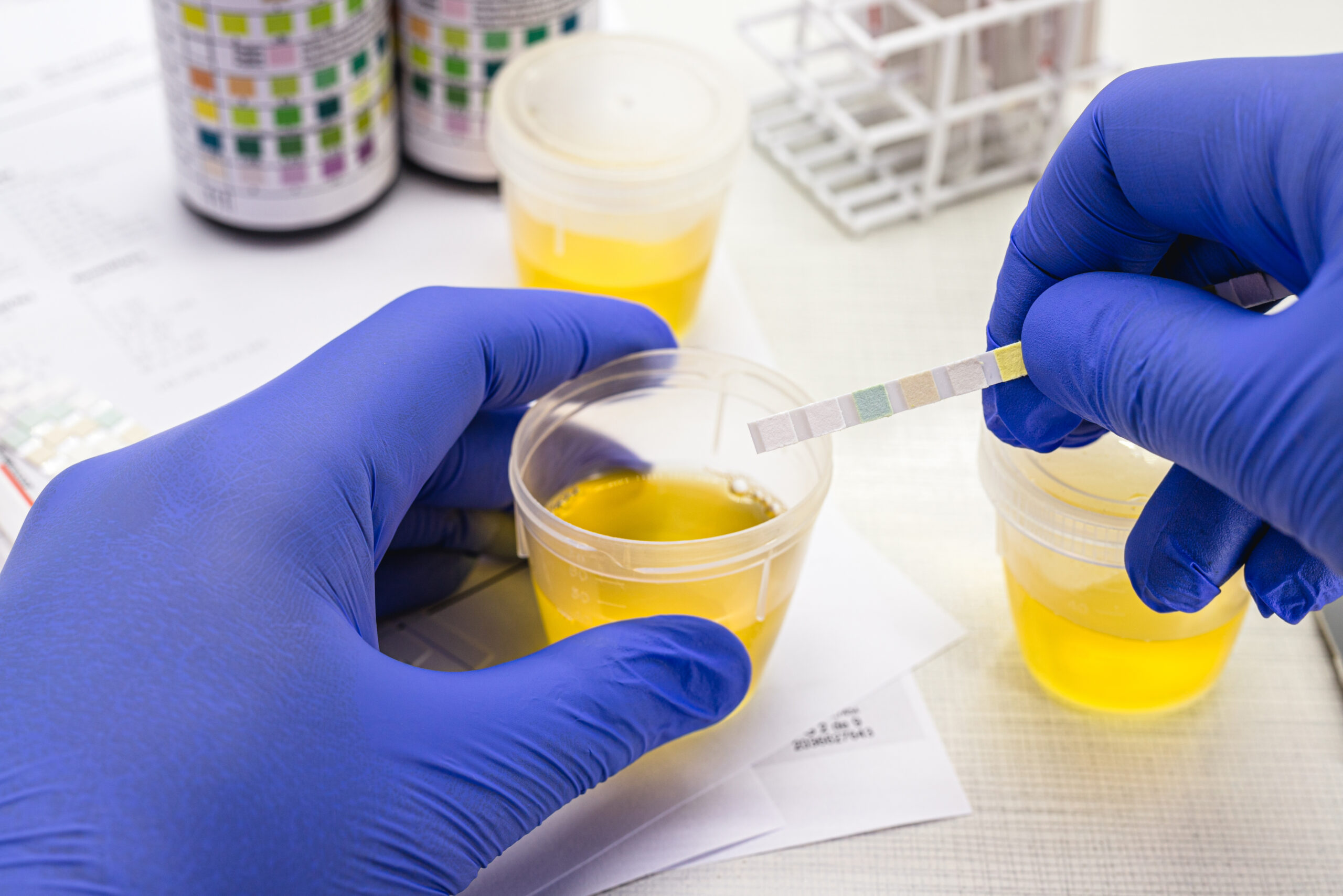 urine test, made with a vial of Urinalysis Reagent Strip used for ketosis control, laboratory examination.